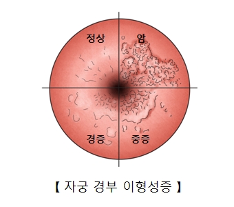 자궁 경부의 이형성증