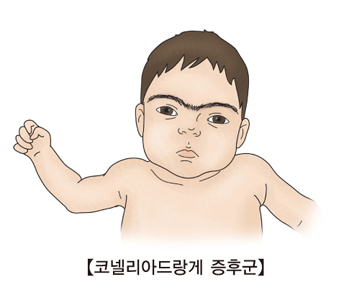 코넬리아드랑게 증후군