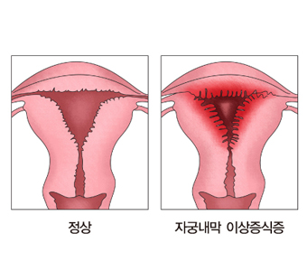 자궁내막 이상증식증