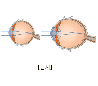 가성근시