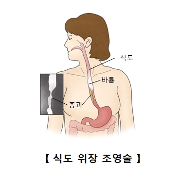 식도이완불능증