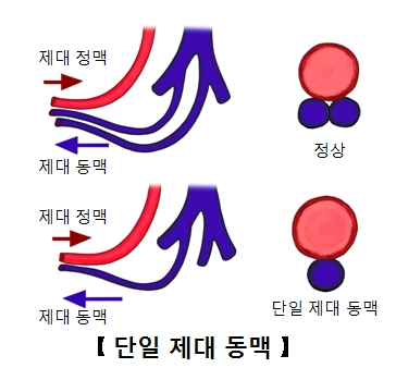 단일제대동맥