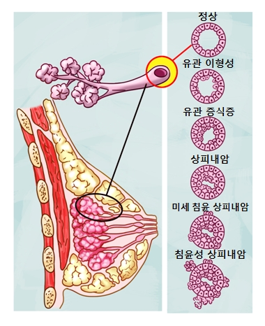 신경절 신경종