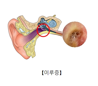 이루증