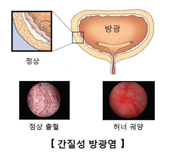 간질성 방광염