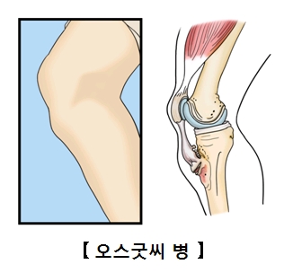 오스굿씨 병