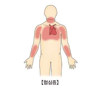 협심증