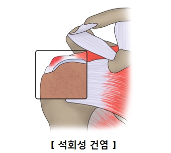 석회성 건염