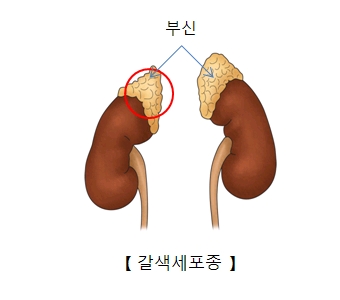 갈색세포종