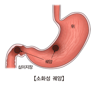 십이지장 궤양