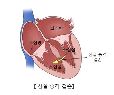 심실중격결손