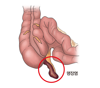 맹장염