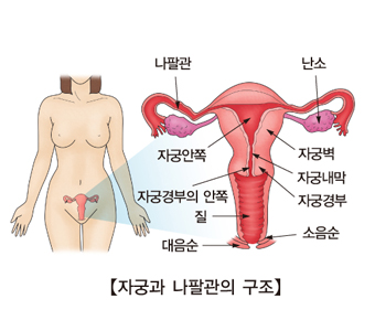 자궁 상피내 암종