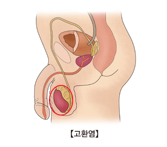 고환염