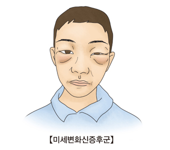 신증후군