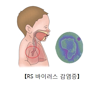 RS바이러스 감염증