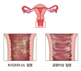 칸디다성 외음질염