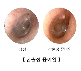 삼출성 중이염