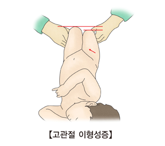 고관절 이형성증