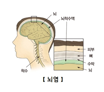 뇌염