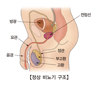 고환 종양