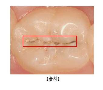 충치