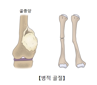 병리적 골절