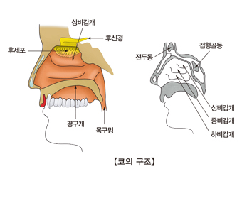 만성 비염