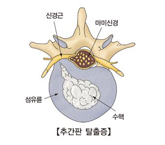 추간판