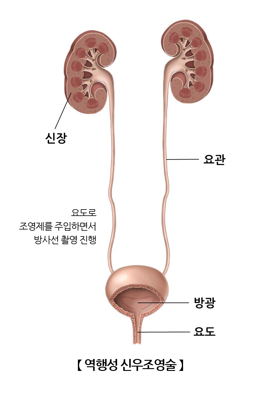 역행성신우조영술