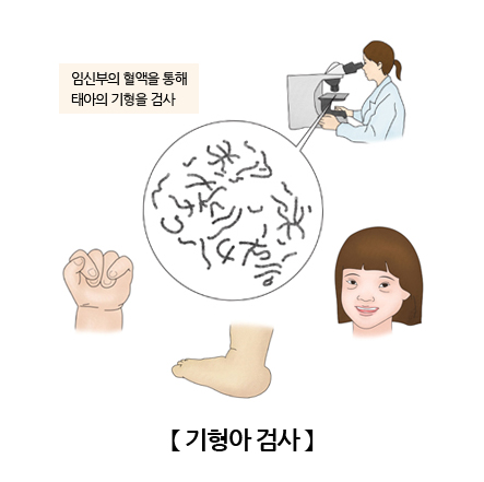 기형아 검사