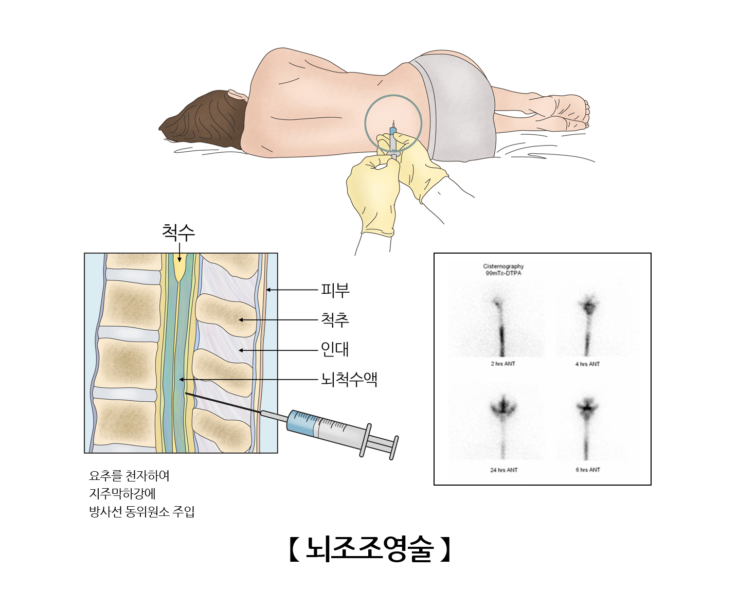 뇌조조영술