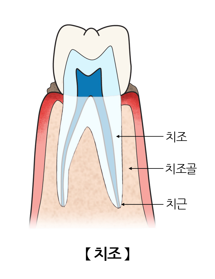 치조